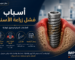 رسم توضيحي يشرح أسباب فشل زراعة الأسنان باستخدام زرعة IMPLA الألمانية مع أبرز العلامات المبكرة وطرق الوقاية للحفاظ على نجاح الزراعة.