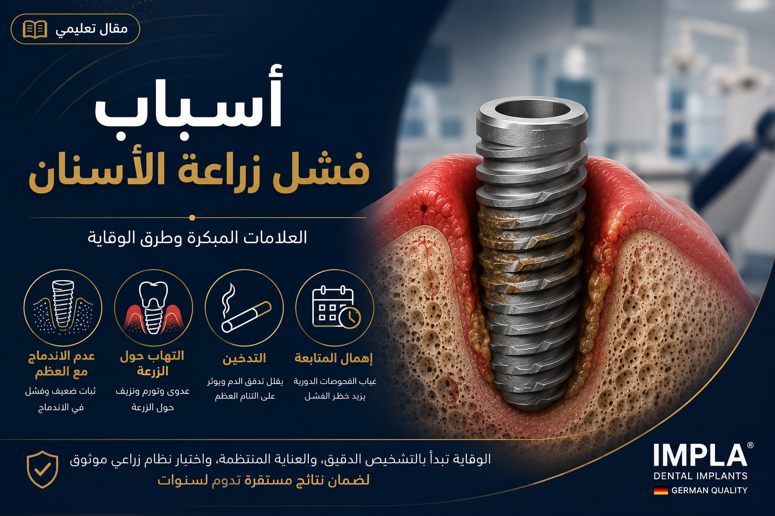 رسم توضيحي يشرح أسباب فشل زراعة الأسنان باستخدام زرعة IMPLA الألمانية مع أبرز العلامات المبكرة وطرق الوقاية للحفاظ على نجاح الزراعة.