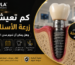 زرعة أسنان IMPLA الألمانية توضح العمر الافتراضي لزراعة الأسنان وإمكانية استمرارها لأكثر من 20 سنة مع العناية المناسبة.