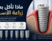 صورة توضيحية لزرعة IMPLA الألمانية داخل عظم الفك تشرح الأطعمة المسموحة والممنوعة بعد زراعة الأسنان خلال فترة التعافي.