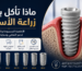 صورة توضيحية لزرعة IMPLA الألمانية داخل عظم الفك تشرح الأطعمة المسموحة والممنوعة بعد زراعة الأسنان خلال فترة التعافي.