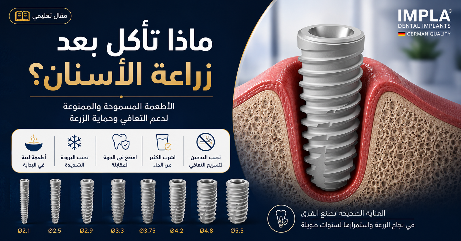 صورة توضيحية لزرعة IMPLA الألمانية داخل عظم الفك تشرح الأطعمة المسموحة والممنوعة بعد زراعة الأسنان خلال فترة التعافي.