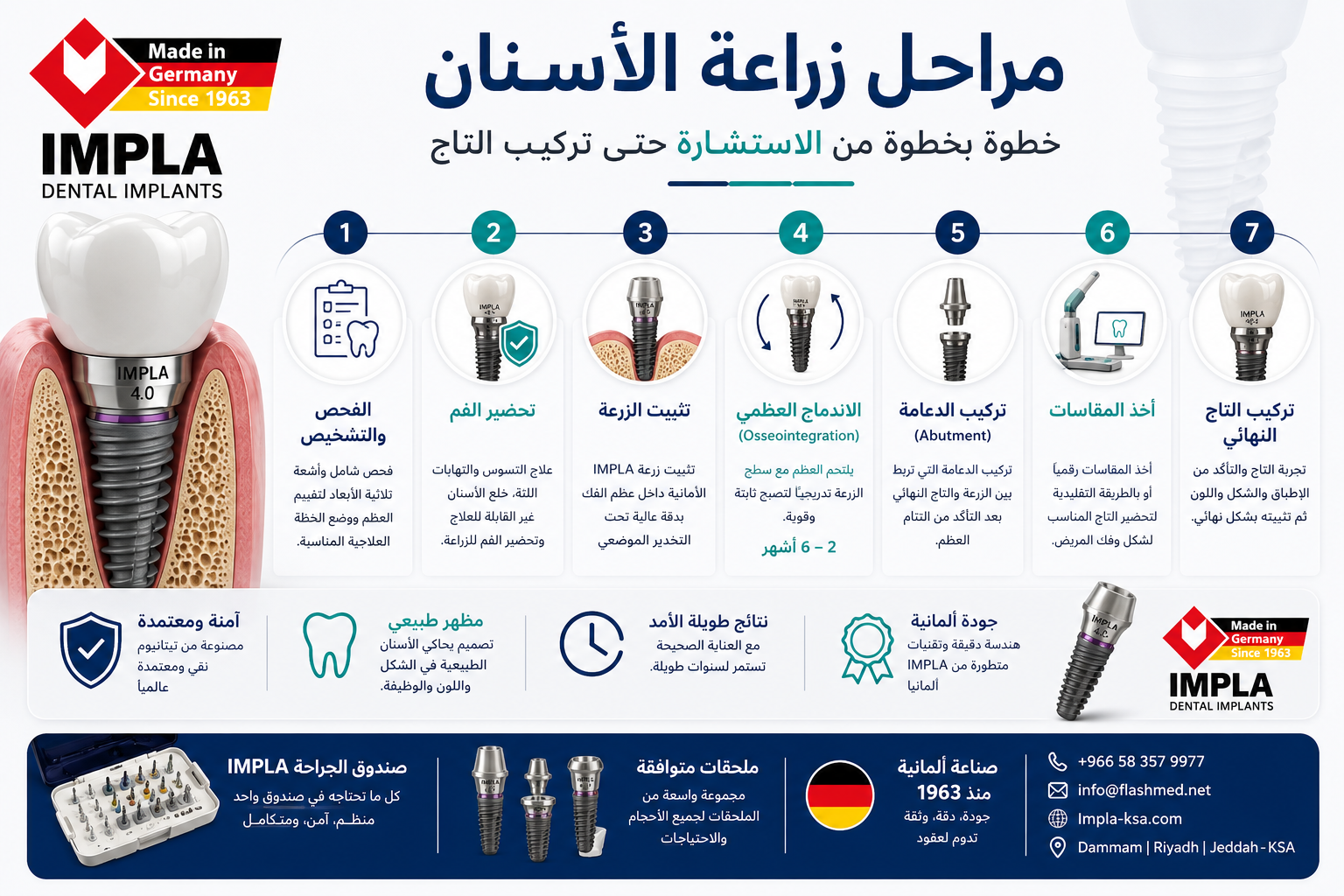 مراحل زراعة الأسنان خطوة بخطوة باستخدام زرعات IMPLA الألمانية من الفحص حتى تركيب التاج النهائي.